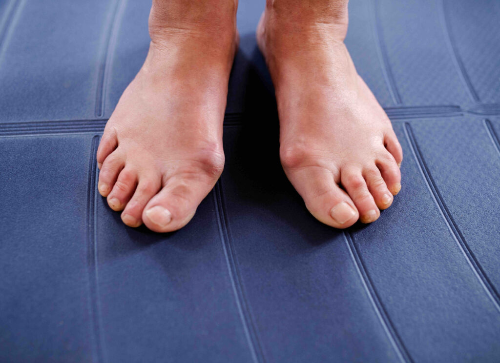 bunion treatment in croydon - medical massage detox