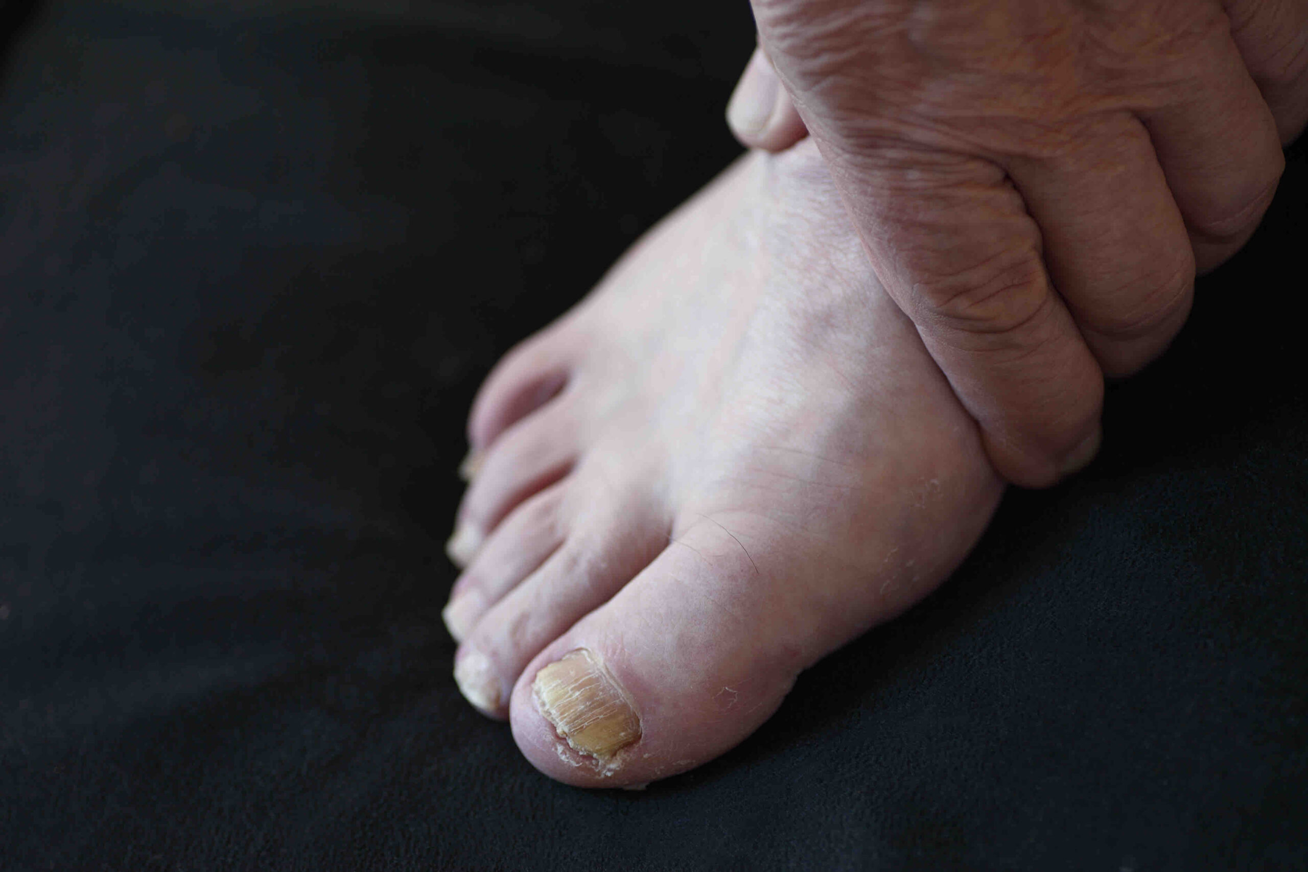 toenail fungus - yellow and thick toenails - medical massage detox - podiatrist in croydon